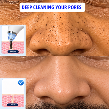 Blackhead Remover Vacuum Device (PCP9)